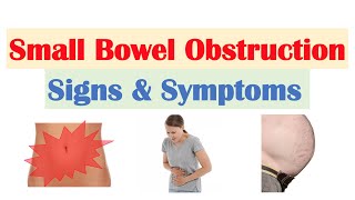 Small Bowel Obstruction SBO Signs amp Symptoms amp Why They Occur [upl. by Masao78]