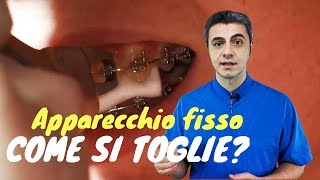 Come si toglie lapparecchio fisso [upl. by Yelkcub]