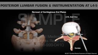 Posterior Lumbar Fusion amp Instrumentation at L45 [upl. by Yorel605]