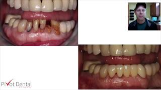 Lower Front Teeth Dental Bridge [upl. by Thanos]