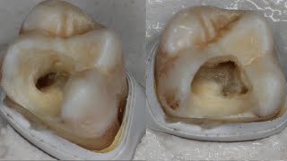 Endodontic series Part 1 Access opening [upl. by Atekehs]