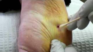 Surgical Plantar Wart Removal [upl. by Costello735]