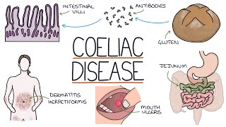 Understanding Coeliac Disease [upl. by Prebo]