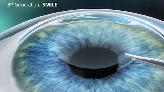 LASIK Commercial  TylockGeorge Eye Care  Greater Dallas TX [upl. by Arries]