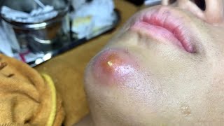 Pimple Popping 2020 Video 65 Blackheads removal Acne removal Acne treatment [upl. by Zebadiah240]