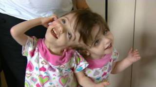 Conjoined Twins Twin Girls A Medical Wonder [upl. by Airdnala]