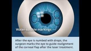 LASIK warning from eye doctor and LASIK patients [upl. by Aerdnael]