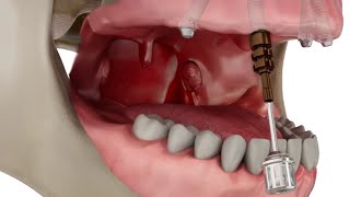 Straumann Pro Arch Step by Step Overview [upl. by Kenay]