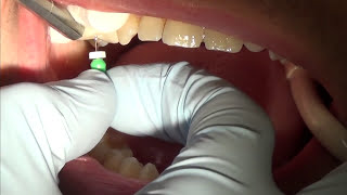 root canal treatment part 1 [upl. by Aliek]