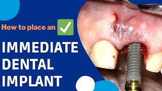 How is an IMMEDIATE DENTAL IMPLANT surgery done implants [upl. by Jere]