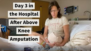 Amputation above the knee surgery day 3 [upl. by Fronniah356]