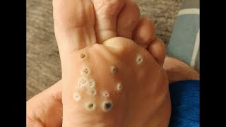 Plantar Wart Removal How to Remove Plantar Warts [upl. by Miche]