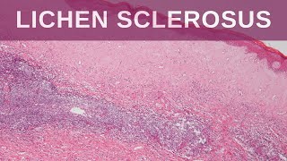 Lichen Sclerosus  Pathology mini tutorial [upl. by Vander659]