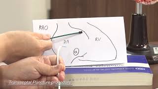 Surgical Ablation During Mitral Valve Surgery [upl. by Dadirac]