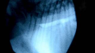 Colapso traqueal fluoroscopia y endoscopia [upl. by Anauqahc]