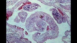 Schistosomiasis  Pathology mini tutorial [upl. by Lipcombe487]