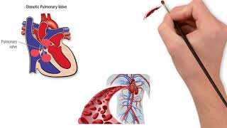 Pulmonary valve stenosis [upl. by Ivie]