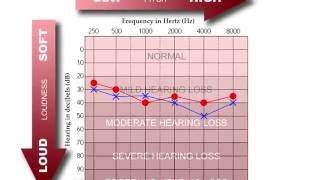 How to Read an Audiogram [upl. by Ssur425]