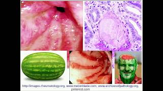 EROSIVE GASTRITIS  Belly Pain And Vomiting [upl. by Ainola]