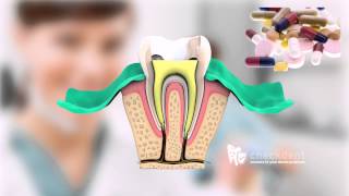 What is a Root Canal Treatment [upl. by Ainesell]