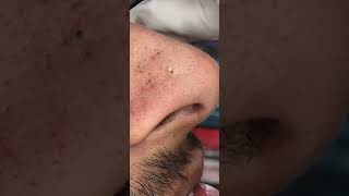 Nose Blackheads shorts [upl. by Pegasus]