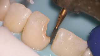 Teeth Bonding  Front tooth filling EXPLAINED [upl. by O'Reilly]