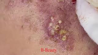 Pimple Removal and Acnes Treatment  BBeauty 07 [upl. by Nedlog617]