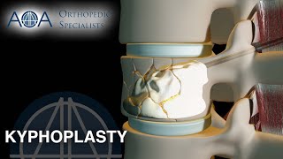 Kyphoplasty An Overview [upl. by Githens]