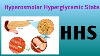 Hyperosmolar Hyperglycemic State  HHS [upl. by Haleigh]