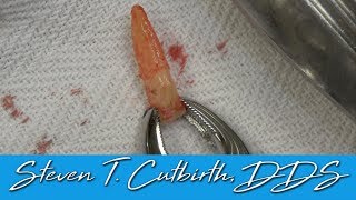 Extracting Mandibular Anterior Tooth  Dental Minute with Steven T Cutbirth DDS [upl. by Saylor]