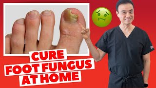 6 Effective HOME REMEDIES To CURE Toenail FUNGUS  Holistic Toenail Fungus Cures Part 2  Dr Kim [upl. by Asiar]