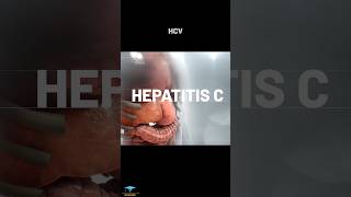 Hepatitis Types [upl. by Adoree]