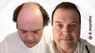 I Got A Hair Transplant In Turkey  Surgeon Reacts [upl. by Monjo]