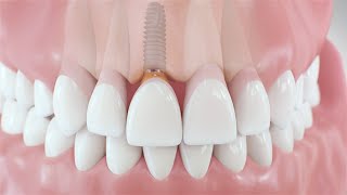 Dental Implant Procedure  Medical Animation [upl. by Charles552]