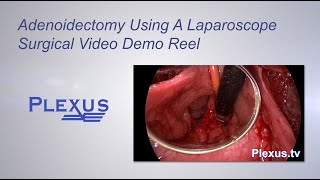 Adenoidectomy Surgical Video [upl. by Enttirb]