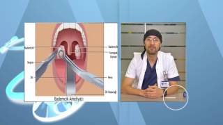 Bademcik İltihaplanması Belirtileri ve Tedavisi Bademcik Ameliyatı Nasıl Yapılır [upl. by Drawoh340]