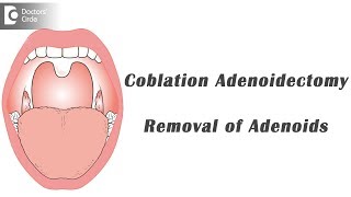 Adenoidectomy [upl. by Nim]