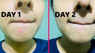 How to remove PIMPLES Overnight  Pimples removal Naturally Before and After [upl. by Aneetsyrk]