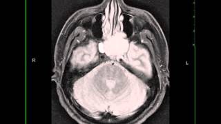 Adrenoleukodystrophy  causes symptoms diagnosis treatment pathology [upl. by Egwan323]