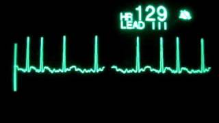 Atrial Fibrillation with RVR [upl. by Ymerrej]