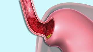 Understanding Dysphagia [upl. by Lashond]