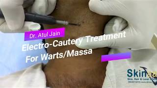 WartsMole Removal Treatment with Electrocautery in Jaipur India – Dr Atul Jain [upl. by Dnalyag]