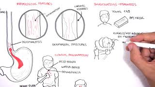 Diabetic Gastroparesis  Symptoms Complications Treatments  Dr Ravindra B S  Doctors Circle [upl. by Atiuqrahs]