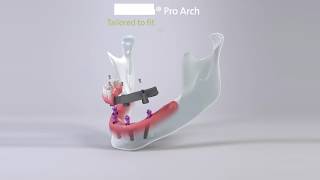 BLX ProArch step by step procedure [upl. by Ykciv929]