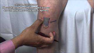 Knee Injection  Anterior Approach [upl. by Flossi735]