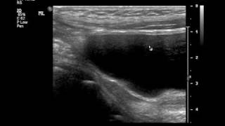 Intussusception US and Reductionmp4 [upl. by Drews]