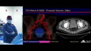 Transradial Prostate Artery Embolization PAE for Symptomatic BPH [upl. by Trudie]