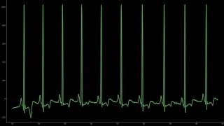 Electrocardiogramme ECG avec extrasystole avec son 1 minute [upl. by Brechtel]