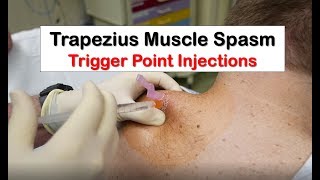 Trapezius Muscle Spasm Trigger Point Injection [upl. by Meehyr804]