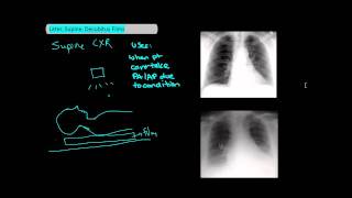 Types of Chest XRays part 2  Lateral Supine Decubitus UndergroundMed [upl. by Halpern948]